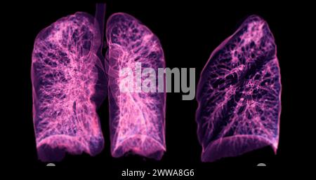 Ein CT-Thorax-3D-Scan, der eine Läsion am rechten Oberlappen zeigt, bietet eine detaillierte Visualisierung, die eine präzise Identifizierung und Behandlungsplanung erleichtert Stockfoto
