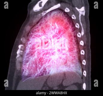 CT-3D-Darstellung von Brust oder Lunge mit Trachea und Lunge im Respirationssystem. Stockfoto