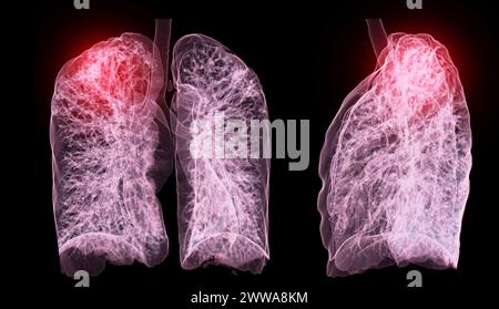 Ein CT-Thorax-3D-Scan, der eine Läsion am rechten Oberlappen zeigt, bietet eine detaillierte Visualisierung, die eine präzise Identifizierung und Behandlungsplanung erleichtert Stockfoto
