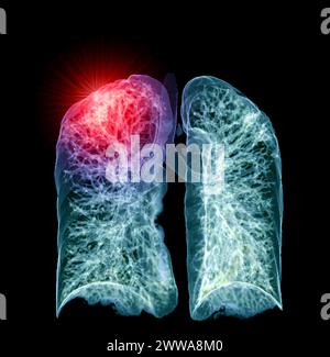 Ein CT-Thorax-3D-Scan, der eine Läsion am rechten Oberlappen zeigt, bietet eine detaillierte Visualisierung, die eine präzise Identifizierung und Behandlungsplanung erleichtert Stockfoto