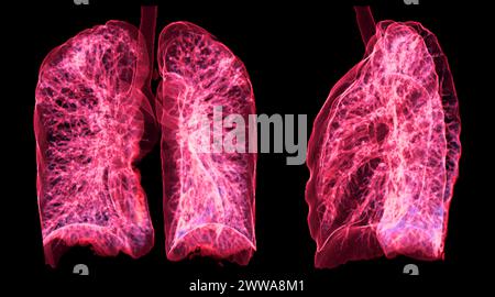 Ein CT-Thorax-3D-Scan, der eine Läsion am rechten Oberlappen zeigt, bietet eine detaillierte Visualisierung, die eine präzise Identifizierung und Behandlungsplanung erleichtert Stockfoto