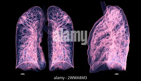 Ein CT-Thorax-3D-Scan, der eine Läsion am rechten Oberlappen zeigt, bietet eine detaillierte Visualisierung, die eine präzise Identifizierung und Behandlungsplanung erleichtert Stockfoto