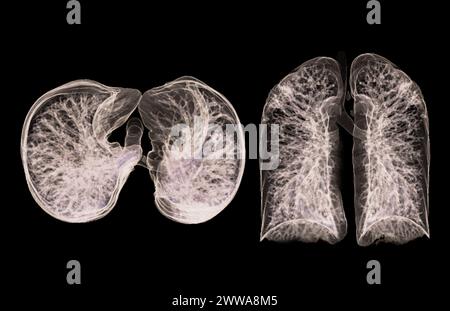 Ein CT-Thorax-3D-Scan, der eine Läsion am rechten Oberlappen zeigt, bietet eine detaillierte Visualisierung, die eine präzise Identifizierung und Behandlungsplanung erleichtert Stockfoto