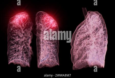 Ein CT-Thorax-3D-Scan, der eine Läsion am rechten Oberlappen zeigt, bietet eine detaillierte Visualisierung, die eine präzise Identifizierung und Behandlungsplanung erleichtert Stockfoto