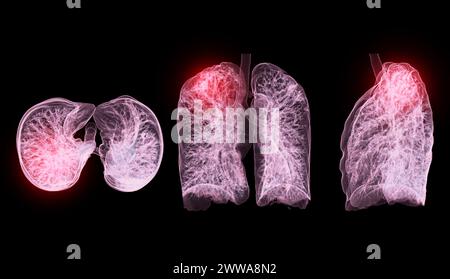 Ein CT-Thorax-3D-Scan, der eine Läsion am rechten Oberlappen zeigt, bietet eine detaillierte Visualisierung, die eine präzise Identifizierung und Behandlungsplanung erleichtert Stockfoto