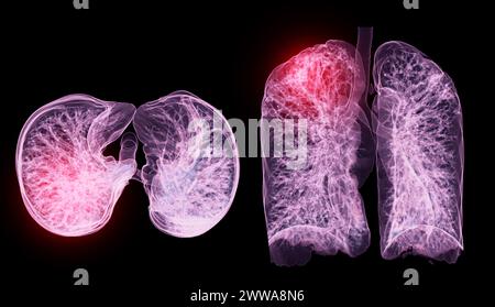 Ein CT-Thorax-3D-Scan, der eine Läsion am rechten Oberlappen zeigt, bietet eine detaillierte Visualisierung, die eine präzise Identifizierung und Behandlungsplanung erleichtert Stockfoto