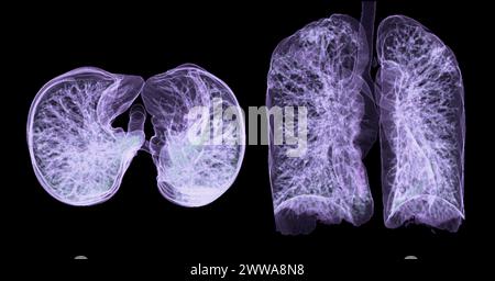 Ein CT-Thorax-3D-Scan, der eine Läsion am rechten Oberlappen zeigt, bietet eine detaillierte Visualisierung, die eine präzise Identifizierung und Behandlungsplanung erleichtert Stockfoto