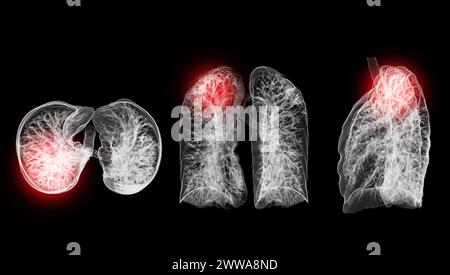 Ein CT-Thorax-3D-Scan, der eine Läsion am rechten Oberlappen zeigt, bietet eine detaillierte Visualisierung, die eine präzise Identifizierung und Behandlungsplanung erleichtert Stockfoto