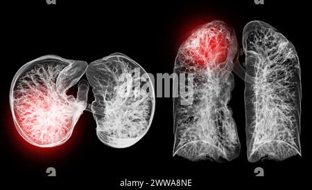 Ein CT-Thorax-3D-Scan, der eine Läsion am rechten Oberlappen zeigt, bietet eine detaillierte Visualisierung, die eine präzise Identifizierung und Behandlungsplanung erleichtert Stockfoto