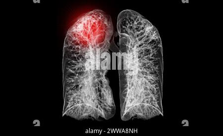 Ein CT-Thorax-3D-Scan, der eine Läsion am rechten Oberlappen zeigt, bietet eine detaillierte Visualisierung, die eine präzise Identifizierung und Behandlungsplanung erleichtert Stockfoto