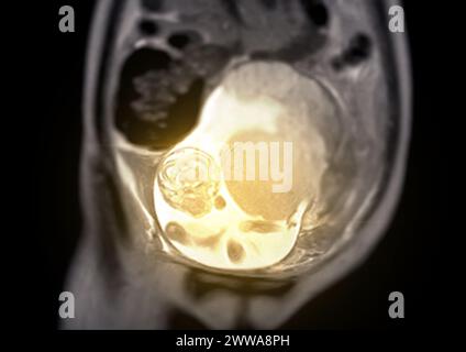 Die MRT während der Schwangerschaft gewährleistet die nichtinvasive Beurteilung der fetalen Gesundheit, der Sicherheit der Mutter, der geburtshilflichen Versorgung und der diagnostischen Präzision und bietet eine detaillierte ima Stockfoto