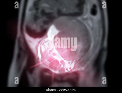 Die MRT während der Schwangerschaft gewährleistet die nichtinvasive Beurteilung der fetalen Gesundheit, der Sicherheit der Mutter, der geburtshilflichen Versorgung und der diagnostischen Präzision und bietet eine detaillierte ima Stockfoto