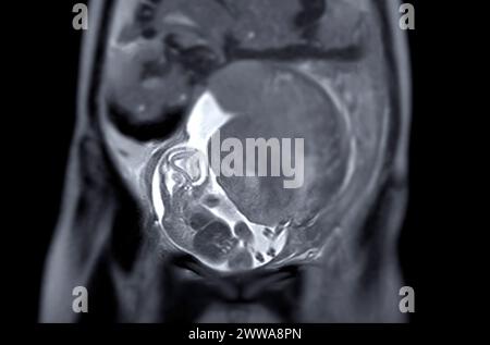 Die MRT während der Schwangerschaft gewährleistet die nichtinvasive Beurteilung der fetalen Gesundheit, der Sicherheit der Mutter, der geburtshilflichen Versorgung und der diagnostischen Präzision und bietet eine detaillierte ima Stockfoto