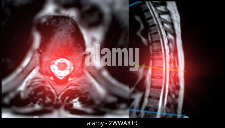 MRT-T-L-Wirbelsäule oder Thorakosakrale Wirbelsäule axiale und sagittale T2-Technik mit Referenzlinie zur Diagnostik der Rückenmarkkompression. Stockfoto