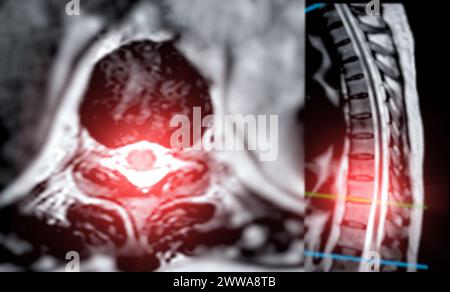 MRT-T-L-Wirbelsäule oder Thorakosakrale Wirbelsäule axiale und sagittale T2-Technik mit Referenzlinie zur Diagnostik der Rückenmarkkompression. Stockfoto