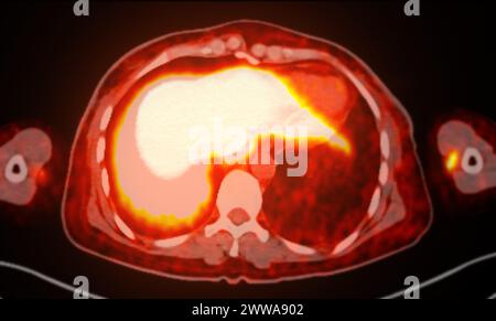 Ein PET-CT-Scan-Bild ist eine diagnostische Visualisierung, die Positronen-Emissions-Tomographie (PET) und Computertomographie (CT) kombiniert, um eine bessere Erkennung zu ermöglichen Stockfoto