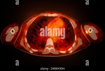 Ein PET-CT-Scan-Bild ist eine diagnostische Visualisierung, die Positronen-Emissions-Tomographie (PET) und Computertomographie (CT) kombiniert, um eine bessere Erkennung zu ermöglichen Stockfoto