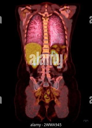 Ein PET-CT-Scan-Bild ist eine diagnostische Visualisierung, die Positronen-Emissions-Tomographie (PET) und Computertomographie (CT) kombiniert, um eine bessere Erkennung zu ermöglichen Stockfoto