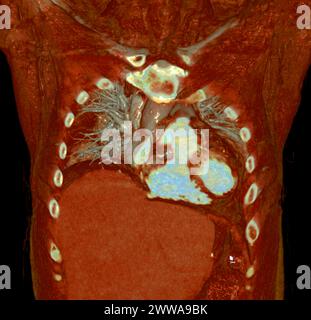 CTA 3D-Rendering der thorakalen Aorta bietet eine detaillierte Visualisierung und liefert klare Einblicke in die Anatomie, Pathologie und die umgebenden Strukturen der Aorten für Stockfoto