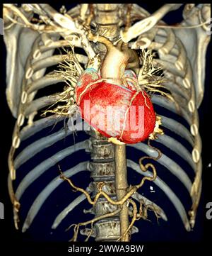 CTA 3D-Rendering der thorakalen Aorta bietet eine detaillierte Visualisierung und liefert klare Einblicke in die Anatomie, Pathologie und die umgebenden Strukturen der Aorten für Stockfoto