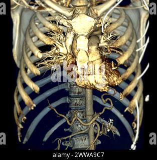 CTA 3D-Rendering der thorakalen Aorta bietet eine detaillierte Visualisierung und liefert klare Einblicke in die Anatomie, Pathologie und die umgebenden Strukturen der Aorten für Stockfoto