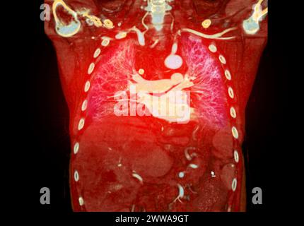 CTA 3D-Rendering der thorakalen Aorta bietet eine detaillierte Visualisierung und liefert klare Einblicke in die Anatomie, Pathologie und die umgebenden Strukturen der Aorten für Stockfoto