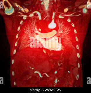 CTA 3D-Rendering der thorakalen Aorta bietet eine detaillierte Visualisierung und liefert klare Einblicke in die Anatomie, Pathologie und die umgebenden Strukturen der Aorten für Stockfoto