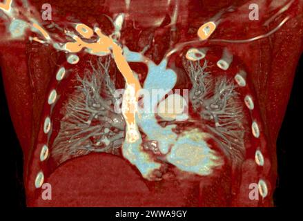 CTA 3D-Rendering der thorakalen Aorta bietet eine detaillierte Visualisierung und liefert klare Einblicke in die Anatomie, Pathologie und die umgebenden Strukturen der Aorten für Stockfoto