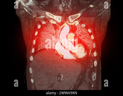 CTA 3D-Rendering der thorakalen Aorta bietet eine detaillierte Visualisierung und liefert klare Einblicke in die Anatomie, Pathologie und die umgebenden Strukturen der Aorten für Stockfoto