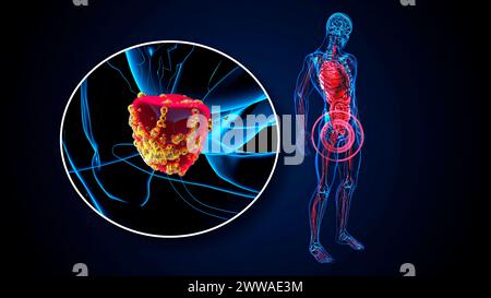 Prostatakarzinom, konzeptuelle Illustration. Stockfoto