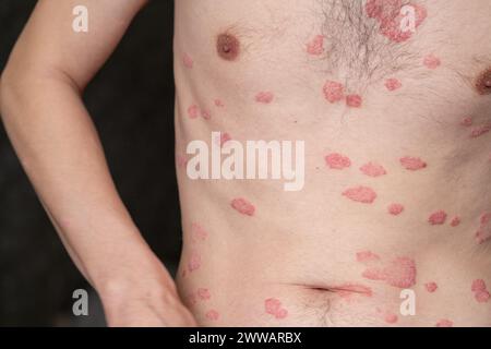 Psoriasis vulgaris, Hautflecken sind in der Regel rot, juckend und schuppig. Stockfoto