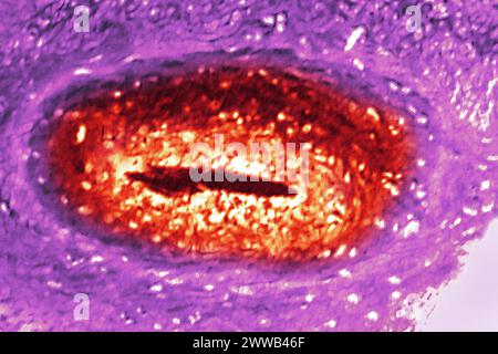 Arteriitis der unteren Gliedmaßen (Krankheit, die die Arterien der Beine betrifft, ist es fast immer auf eine Ablagerung von Cholesterin in den Arterien zurückzuführen. Stockfoto