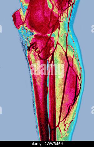 Arteriographie oder Angiographie (radiologische Untersuchung der Arterien einer unteren Extremität im Profil). Stockfoto