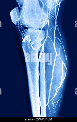 Arteriographie oder Angiographie (radiologische Untersuchung der Arterien einer unteren Extremität im Profil). Stockfoto