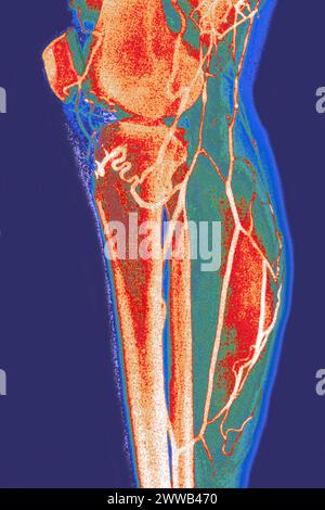 Arteriographie oder Angiographie (radiologische Untersuchung der Arterien einer unteren Extremität im Profil). Stockfoto