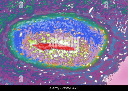 Arteriitis der unteren Gliedmaßen (Krankheit, die die Arterien der Beine betrifft, ist es fast immer auf eine Ablagerung von Cholesterin in den Arterien zurückzuführen. Stockfoto