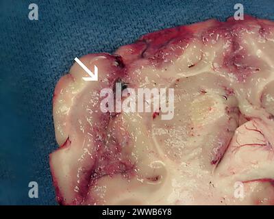 Fokale Blutung und Nekrose der Frontalrinde durch Naegleria fowleri. Stockfoto