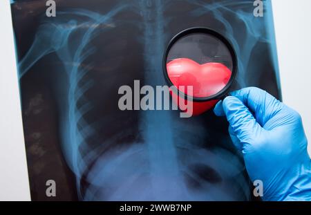Hand hält Lupe auf Röntgenstrahlen einer menschlichen Brust. Medizinisches Konzept Stockfoto