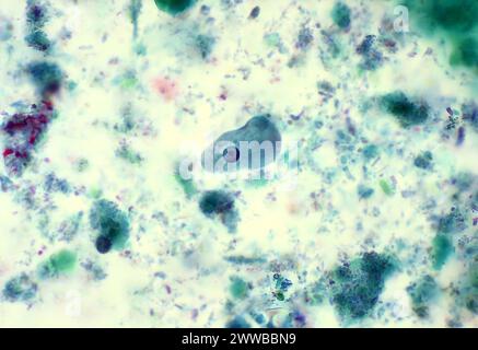 Auf diesem trichromen Objektträger wurde ein Entamoeba histolytica trophozoit entdeckt, der einen atypischen Kern aufweist. Stockfoto