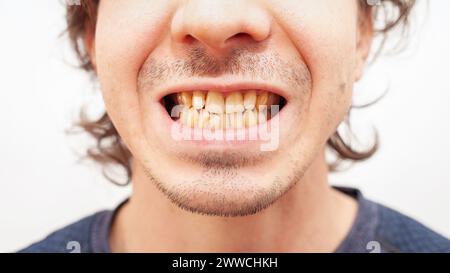 Nahaufnahme Porträt Lächeln Zähne Mann. Gelbe hässliche Zähne vom Rauchen, Alkohol, Krankheit. Krumm, dreckig, isoliert Stockfoto