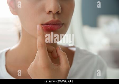 Frau mit Herpes, die Lippen vor verschwommenem Hintergrund berührt, Nahaufnahme Stockfoto