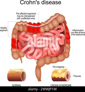 Morbus Crohn. Menschlicher Dick- und Dünndarm mit gesunden Segmenten und Entzündungen, die Schichten der Darmwand beeinflussen. Das betroffene Segment Stock Vektor