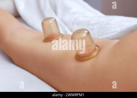 Der Masseur massiert mit Gläsern Cellulite auf dem Gesäß und den Oberschenkeln des Patienten. Behandlung des Übergewichts. Stockfoto