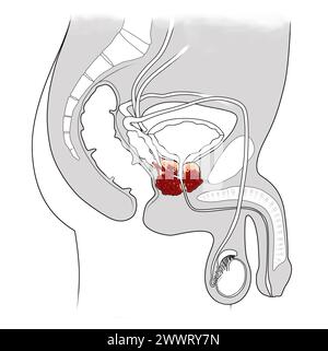 Darstellung des Prostatakarzinom-Querschnitts mit karzinoser Prostata Stockfoto