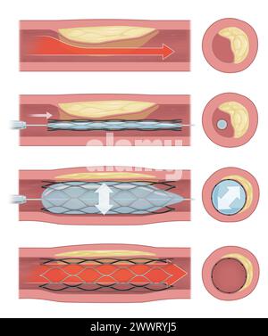 Stentimplantation zur Unterstützung der Durchblutung in die Gefässe Stockfoto