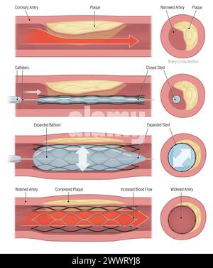 Stentimplantation zur Unterstützung der Durchblutung in die Gefässe Stockfoto