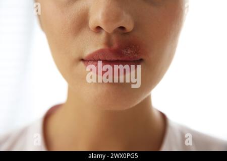 Frau mit Herpes auf der Lippe vor hellem Hintergrund, Nahaufnahme Stockfoto