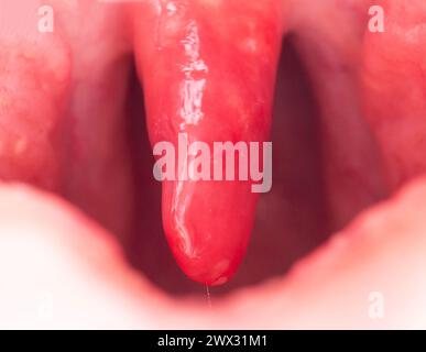 Lange Uvula mit Entzündung von Infektionen und Viren. Die Behandlung der Uvulitis bei Kindern und Erwachsenen. Halsschmerzen, Halsschmerzen. Stockfoto