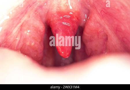 Lange Uvula mit Entzündung von Infektionen und Viren. Die Behandlung der Uvulitis bei Kindern und Erwachsenen. Halsschmerzen, Halsschmerzen. Stockfoto