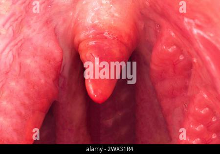 Uvulitis und Halsschmerzen in der Mundhöhle durch Krankheit. Entzündung der Uvula und Mandeln durch Infektionen während der Krankheit, Nahaufnahme Stockfoto